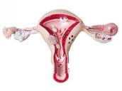 Síndrome de ovario poliquístico y la fertilidad