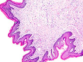 Biopsia de endometrio